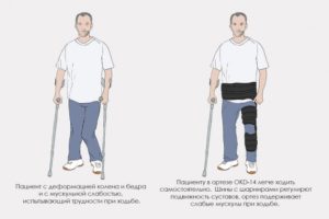Коленно-бедренный ортез OKD-14